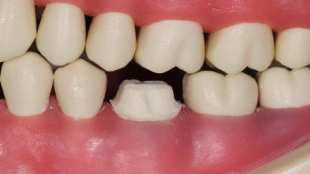 Dental Crowns (Prep-Temp-Final)