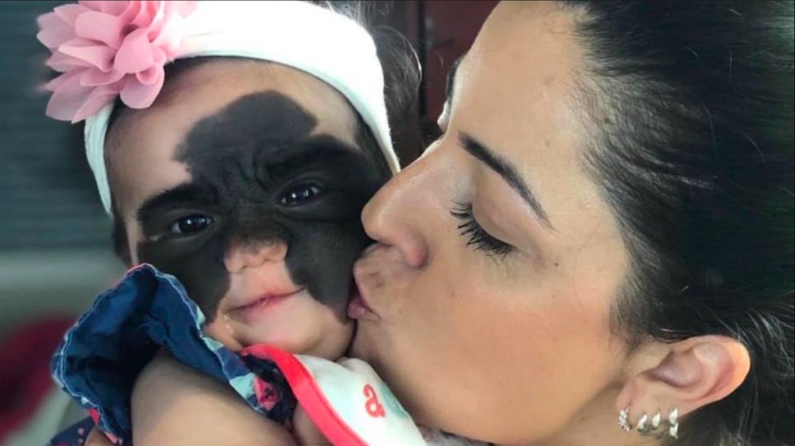 Niña con marca de Batman en la cara fue operada con éxito y luce su nuevo rostro
