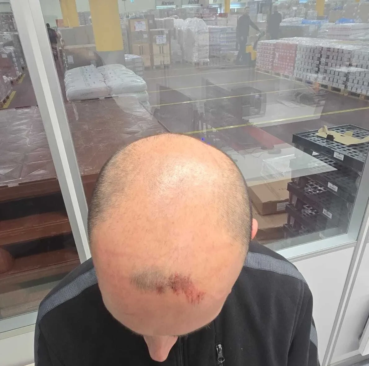 Before: advanced hair loss with fine, weak donor hair, prior to PRP preparation and FUE surgery