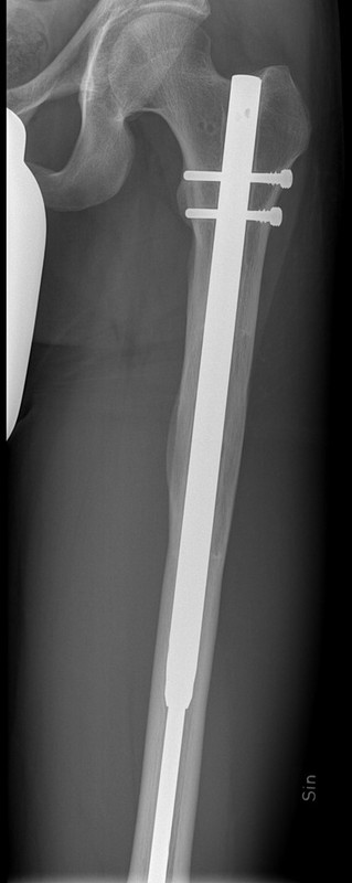 Surgeons who are CAREFUL about the length of their screws?