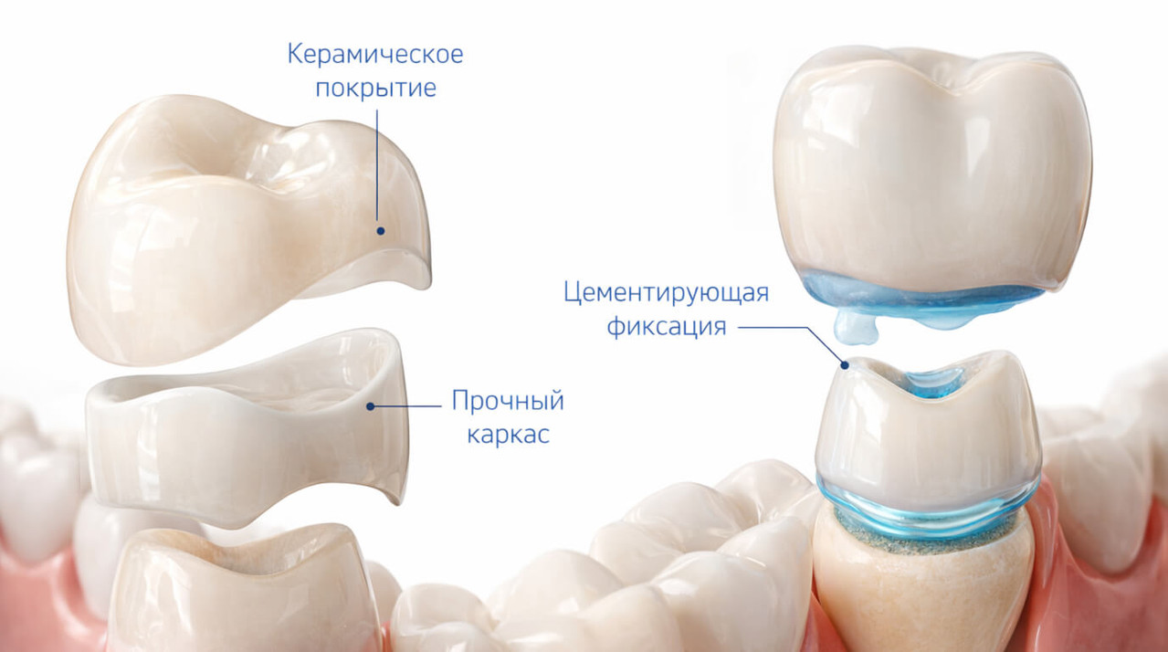 Фотореалистичное изображение слоев керамической коронки