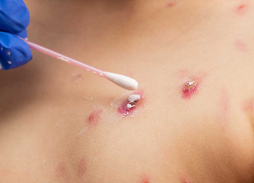 Ya son seis casos sospechosos de viruela del mono en Brasil