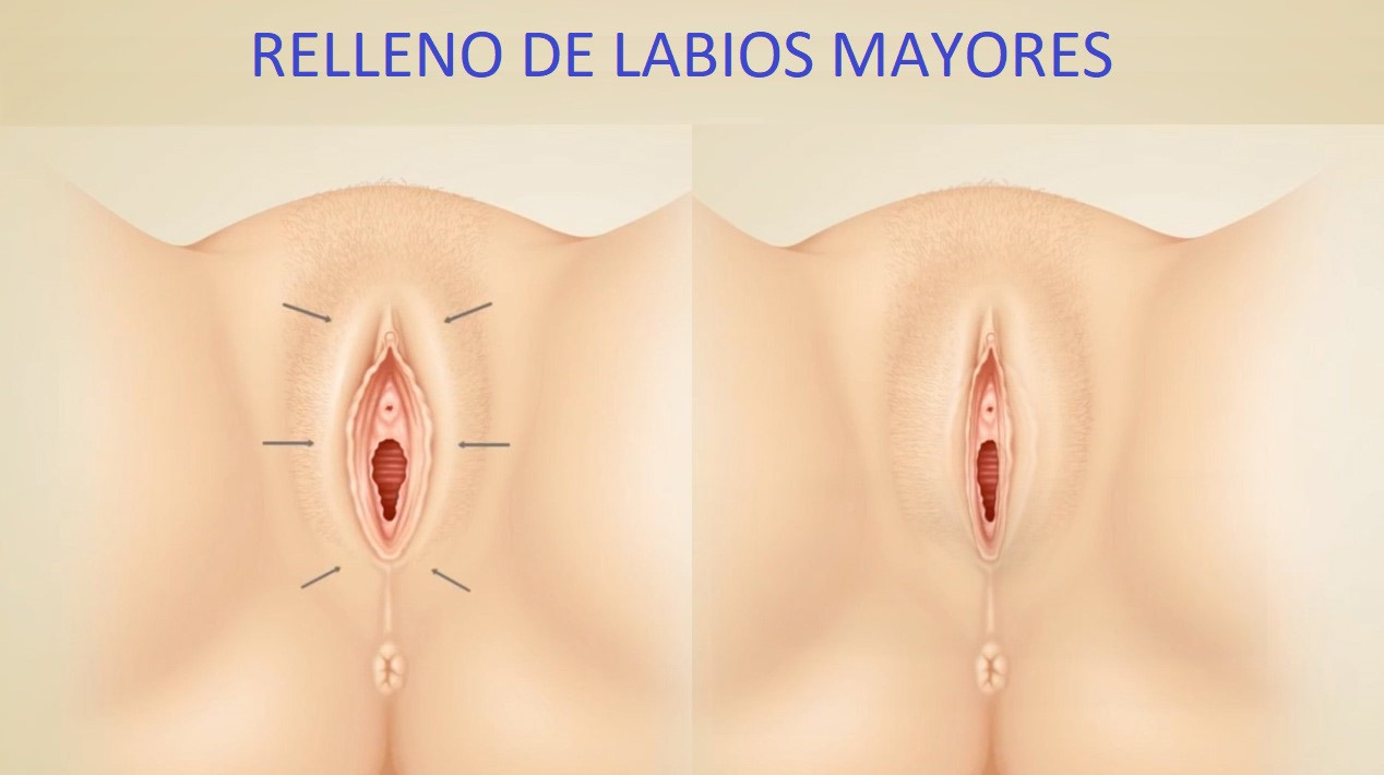 relleno labios mayores