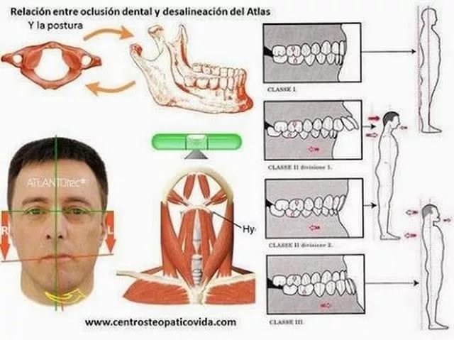 влияние прикуса на осанку