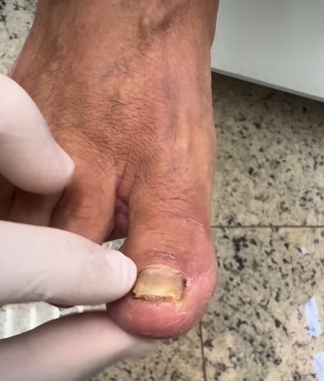 Aplicação da Solução para Micose de Unhas Farmafine