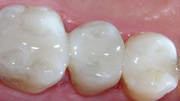 Tooth-Colored Fillings
