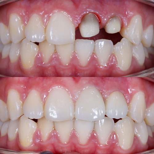 Cosmetic Crowns