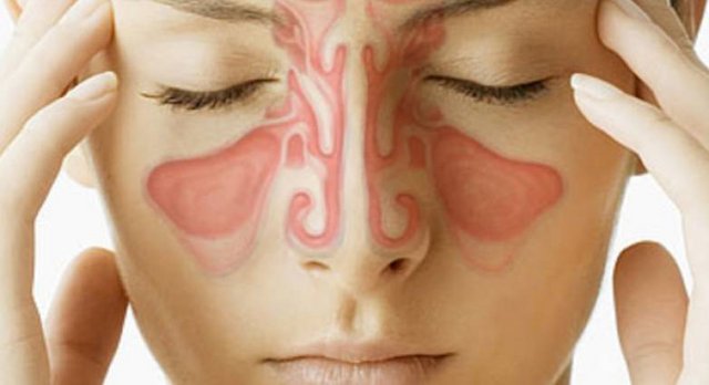 sinusitis-666x399.jpg