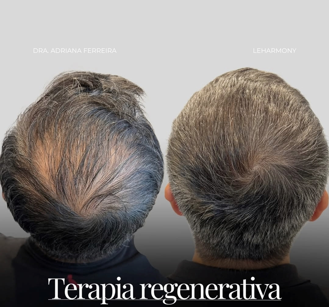 Antes e depois da terapia regenerativa 5