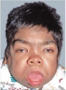 Coarse facies with macrocephaly, prominent forehead, depressed nasal bridge, and thickened facial features in a child with mucopolysaccharidosis