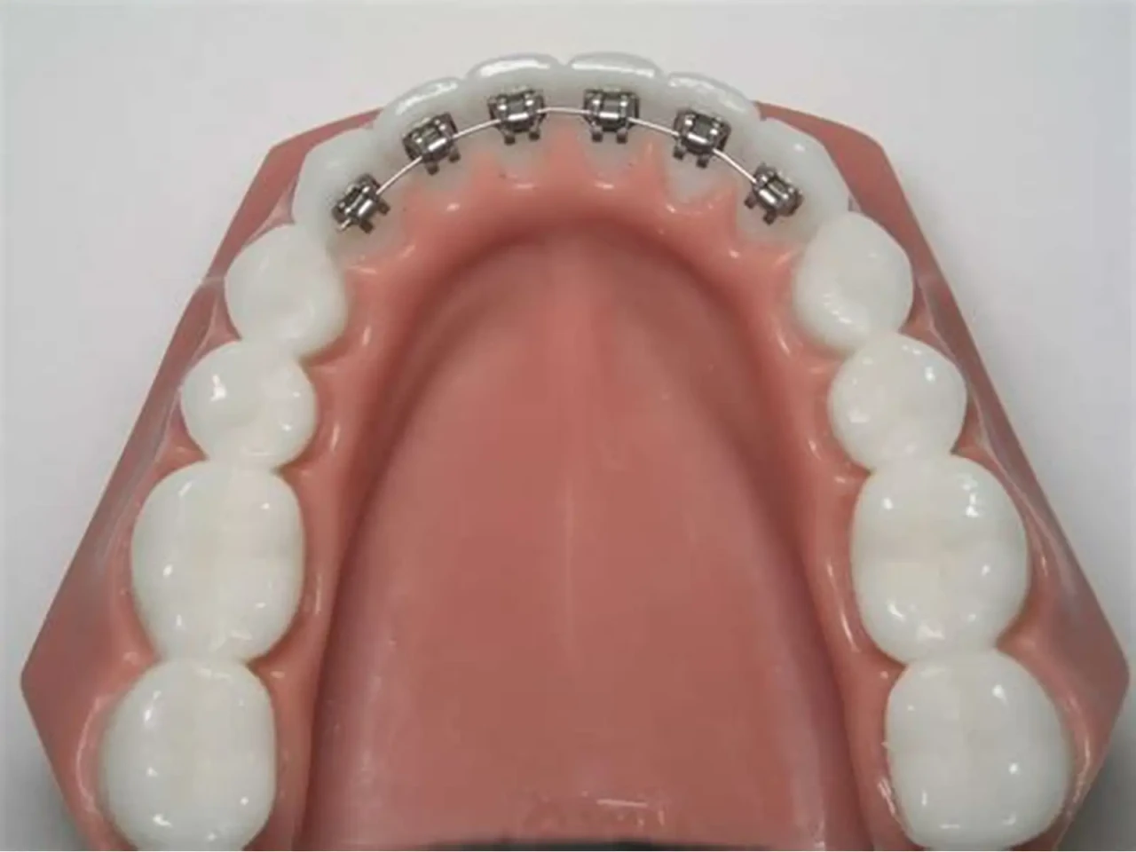 Your Confidence Journey With Lingual Braces Starts Behind the Smile