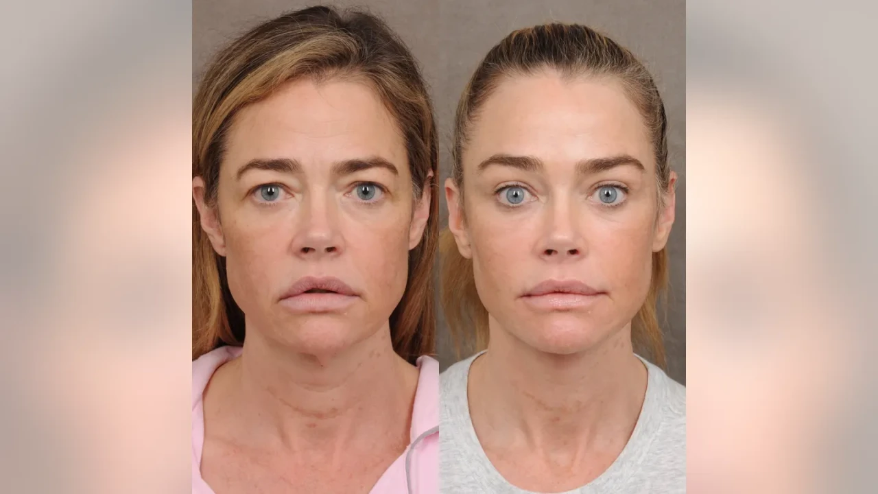denise-richards-facelift-forward.webp