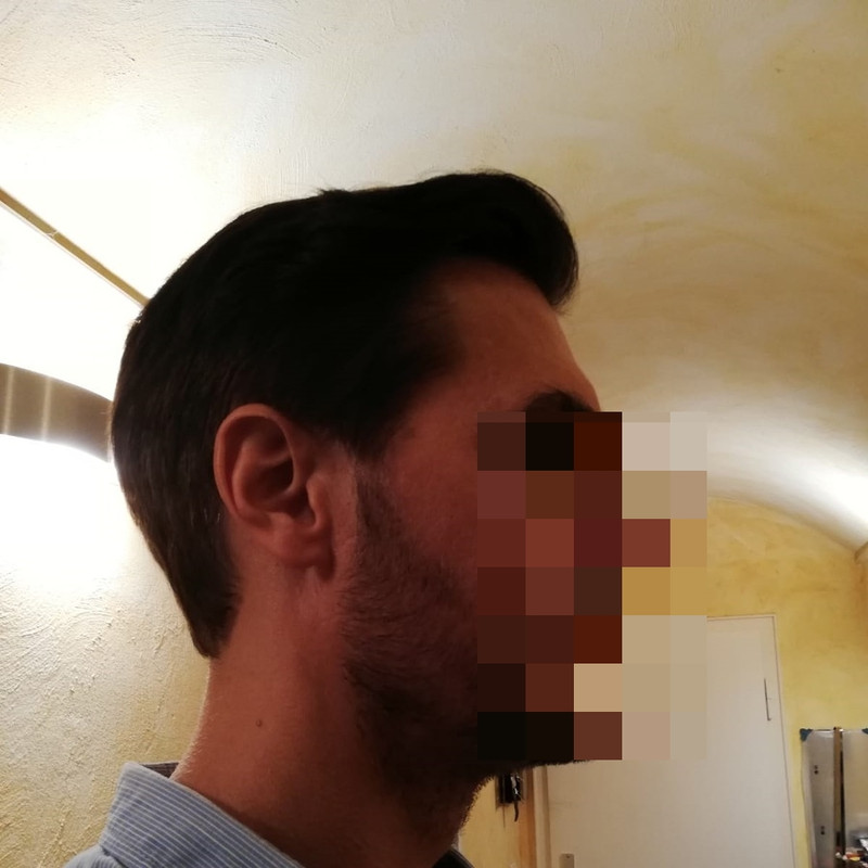 16 mesi 2001 grafts dense pack (1)