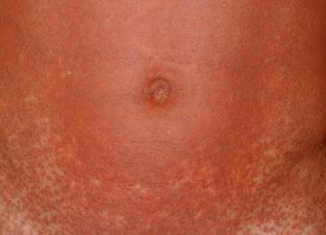 Infectious Diseases question 10 image