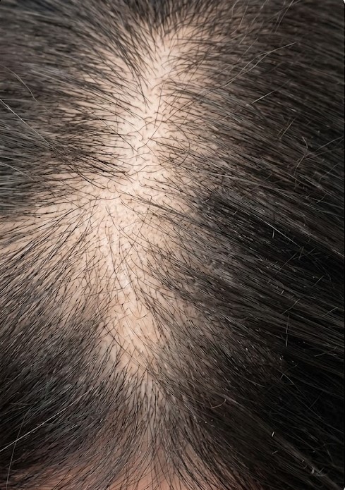 Before - Scalp Therapy Comb