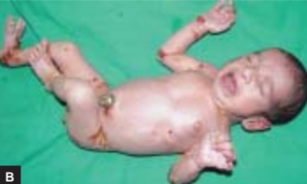 Clinical photograph showing widespread tense bullae, erosions, and crusted lesions on the trunk and extremities in a neonate with junctional epidermolysis bullosa