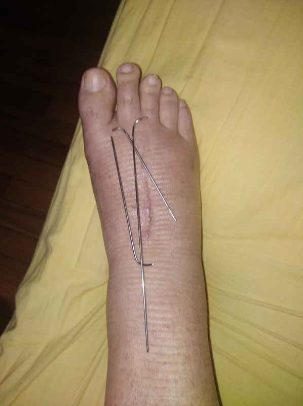 Puedo Quitarme La Bota Walker Para Dormir