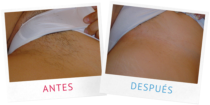 Antes y después 1