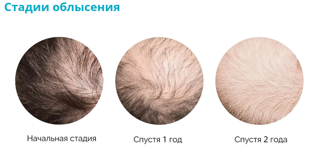 Стадии облысения