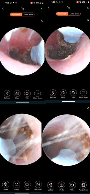 Inside of my ears (unfortunately)