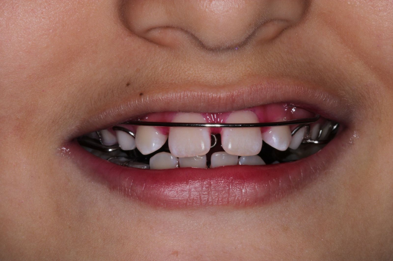 Guía dental en desarrollo