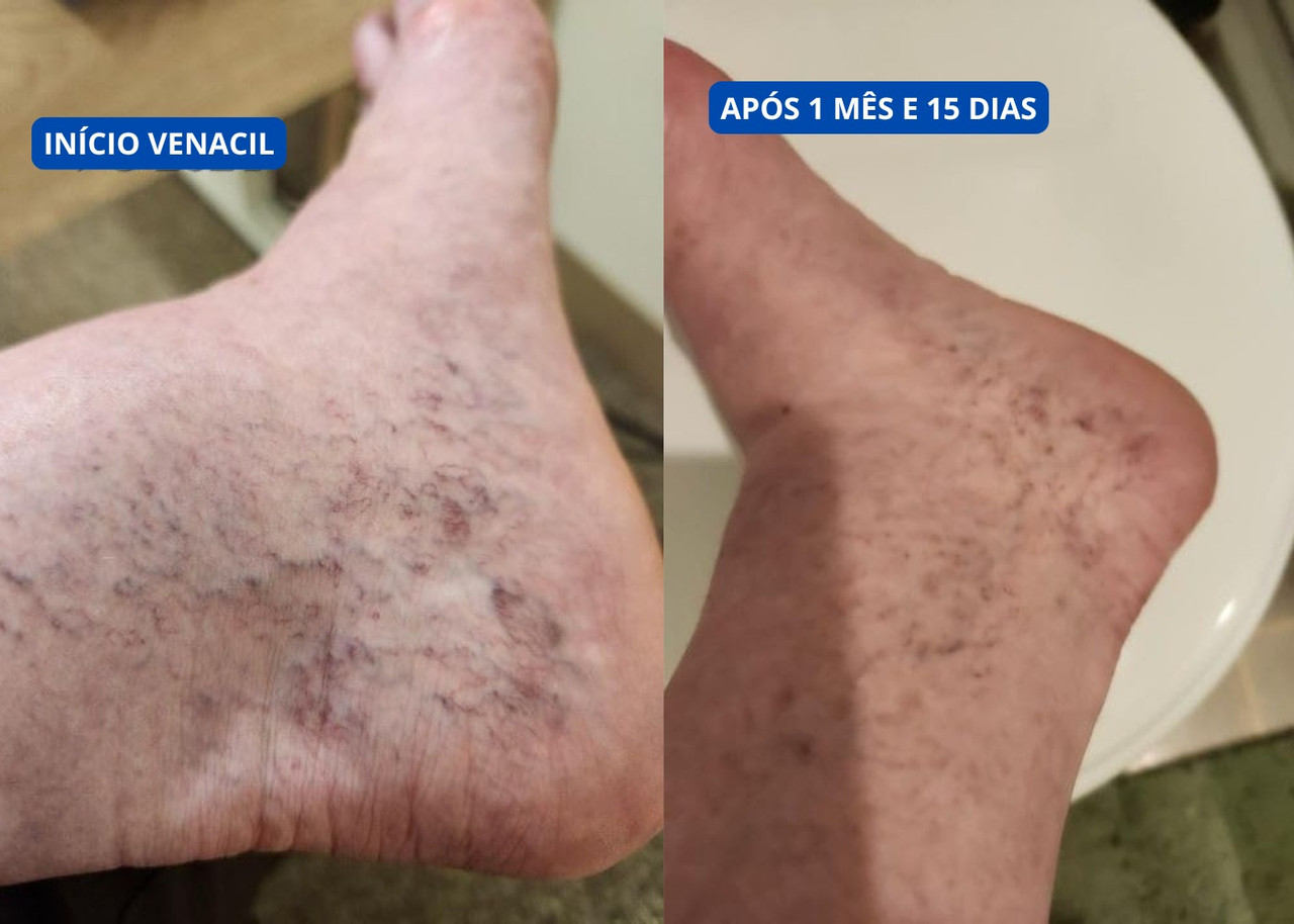 Antes e depois cliente creme para varizes