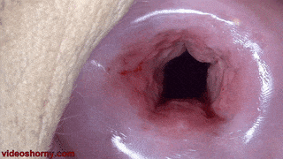 Cervix Dilation Stretching the Uterus with Cervix Penetration