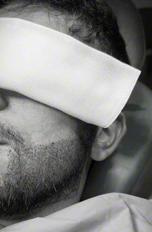 Resultado de transplante de barba 3