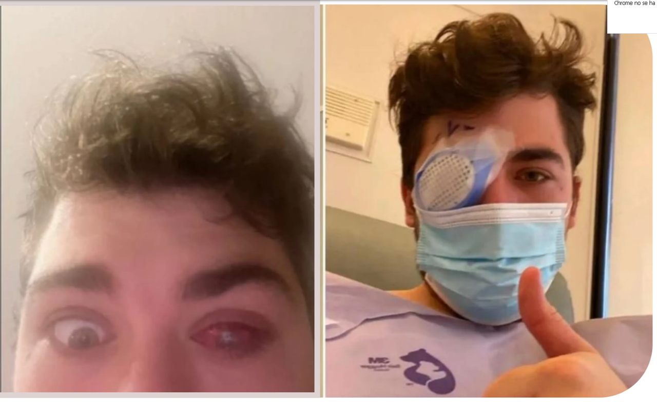 Joven olvida quitarse lentes de contacto para dormir y casi pierde un ojo