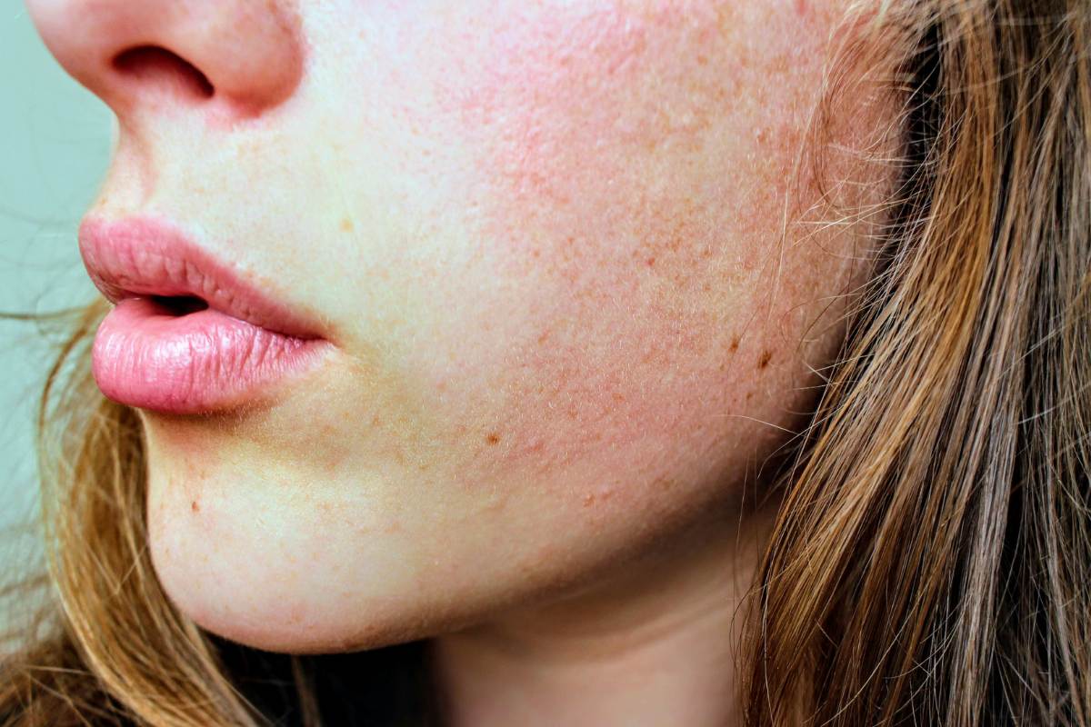  a girl with damaged skin, redness on skin, redness on face, and red dry patches on face