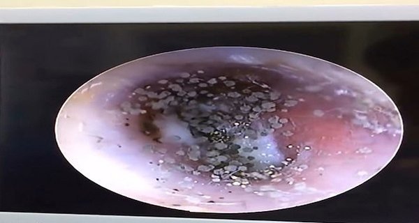 Jamur yang tumbuh di saluran telinga atau biasa disebt mycosis ear canal.