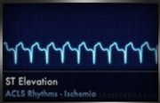 ST elevation