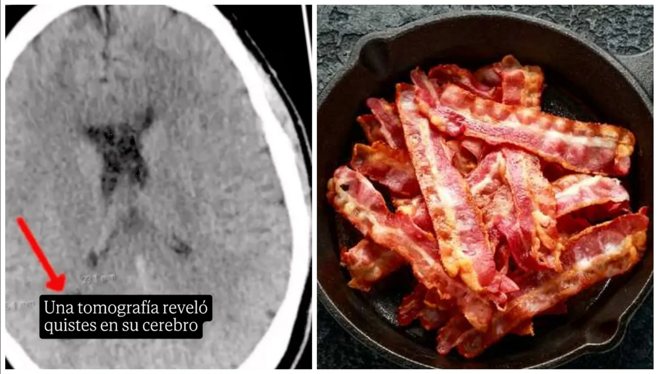 Paciente con migrañas tenía larvas en el cerebro por comer carne de cerdo