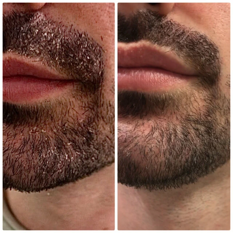 Antes y después barba