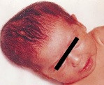 Cephalohematoma - well-defined swelling over right parietal bone, does not cross suture lines