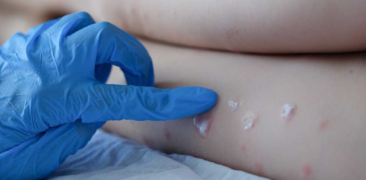 Japón confirma primer caso de Viruela del mono 