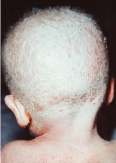 Clinical photograph showing severe scaling and erythema of the scalp with sparse, brittle hair in a child with Netherton syndrome