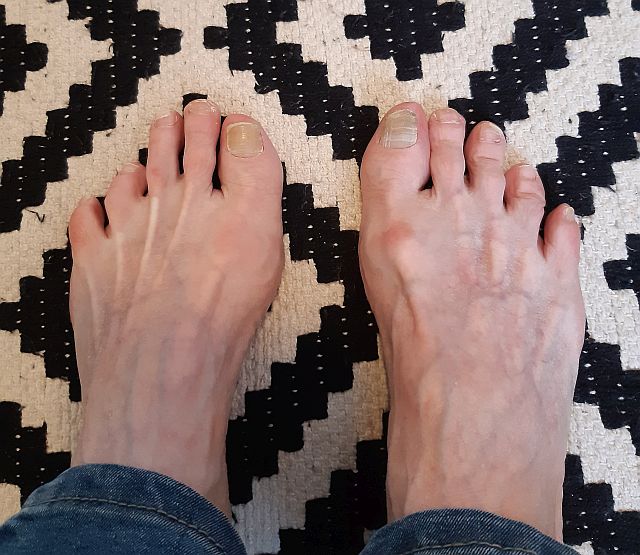 Pictures manky feet International Feet