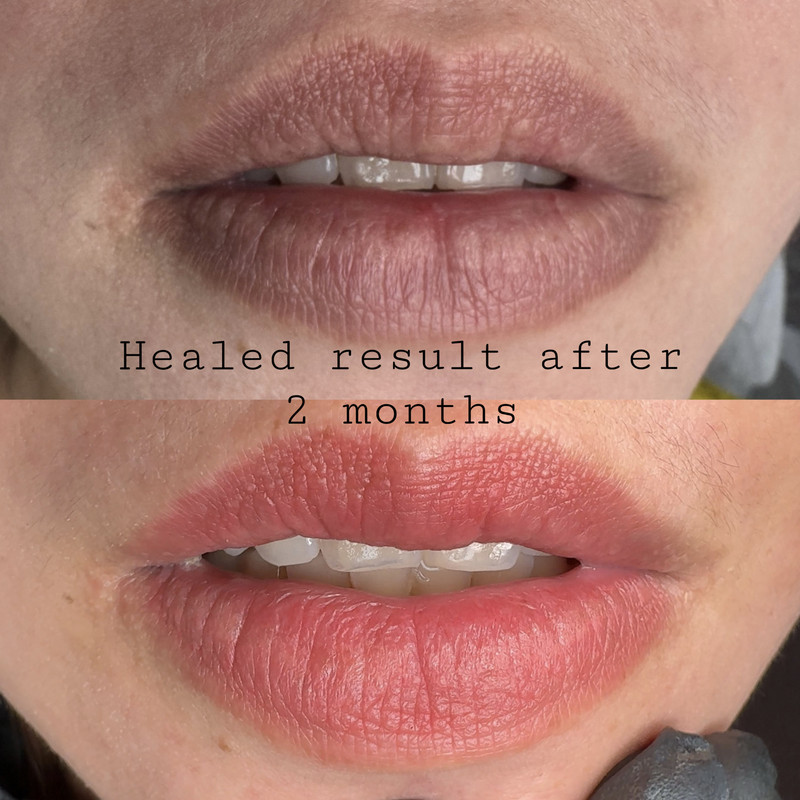Lip Enhancement Example New 2