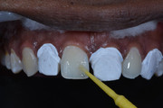 Direct Veneers