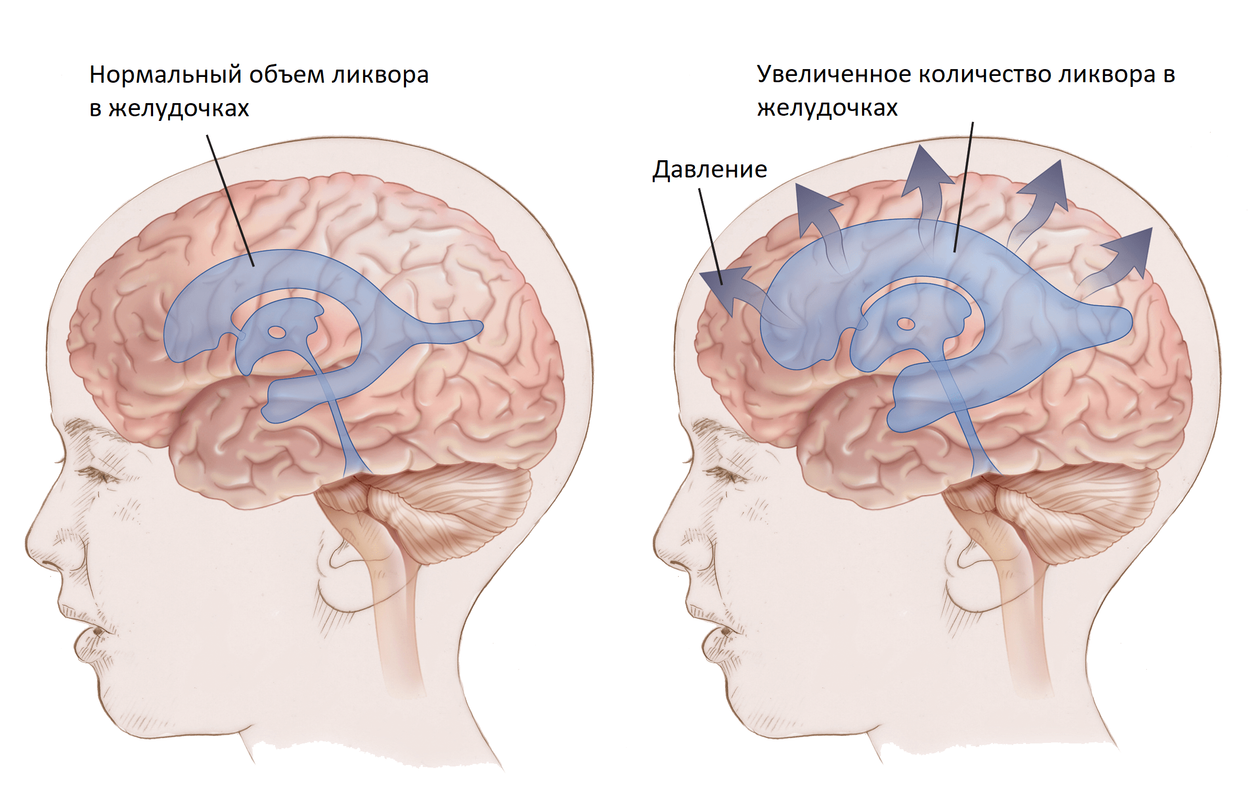 Внутренние признаки головного мозга. Водянка головного мозга ликвор. Гидроцефалия желудочков головного мозга. Желудочки головного мозга при гидроцефалии.
