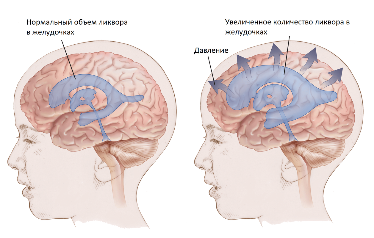 Отек мозга у новорожденных