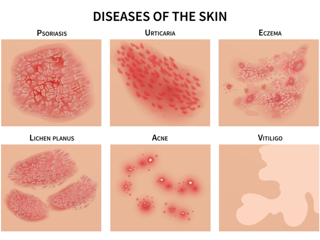 Complex skin disorders