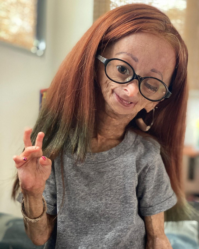 Adaelia Rose pengidap penyakit langka Progeria