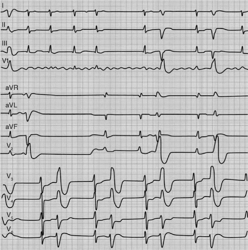 ЭКГ при МС и ФП; желудочковая бигеминия на фоне терапии дигоксином.