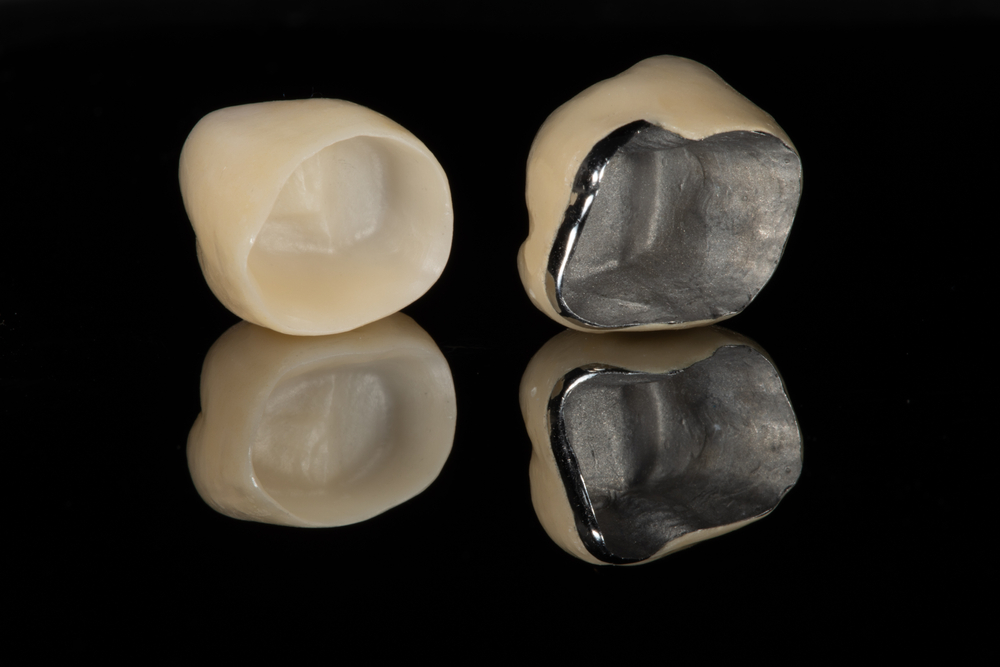 Diagnosing the Need: Why We Still Choose Porcelain Fused to Metal Crowns