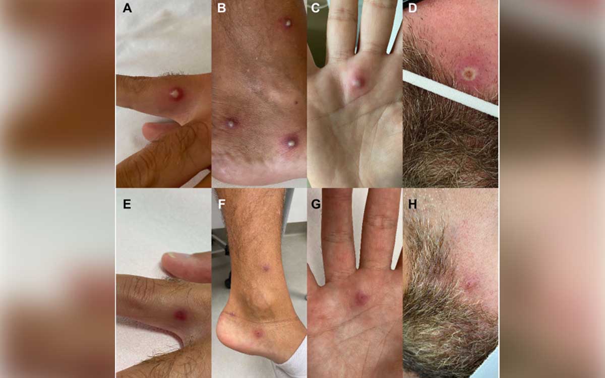 vaiolo scimmie covid hiv catania