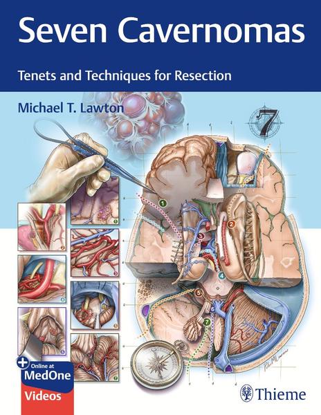 Seven Cavernomas Tenets And Techniques For Resection (2026) (Michael T. Lawton)