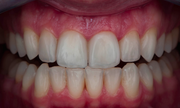 Indirect Veneers