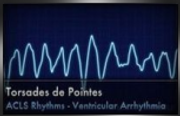 torsades de pointes